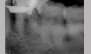 Root canal treatment in Anand
                        